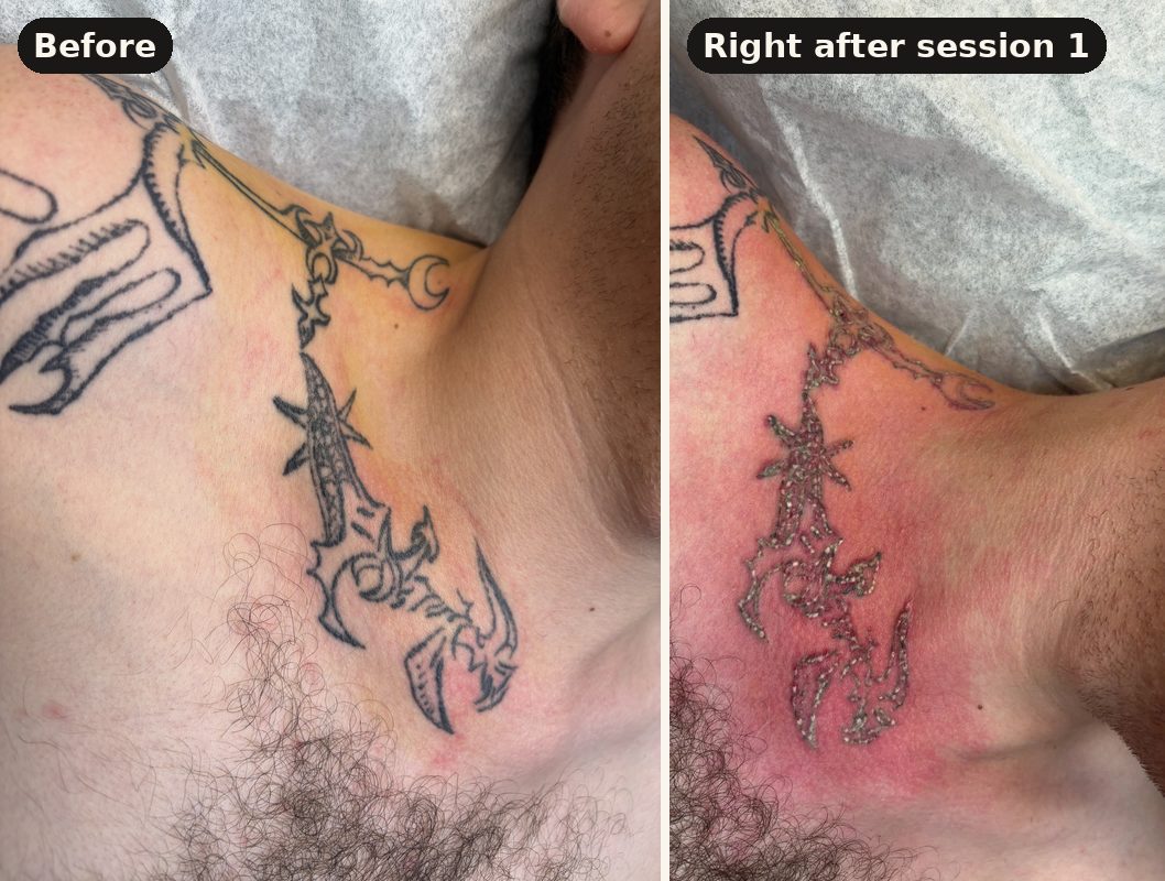 Black ink tattoo before laser removal and right after the first session showing frosting
