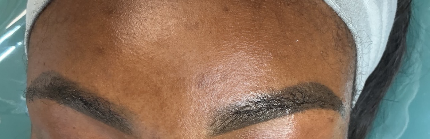 Eyebrow tattoo removal after one session on melanated skin in Atlanta, showing lightened and softened brow pigment