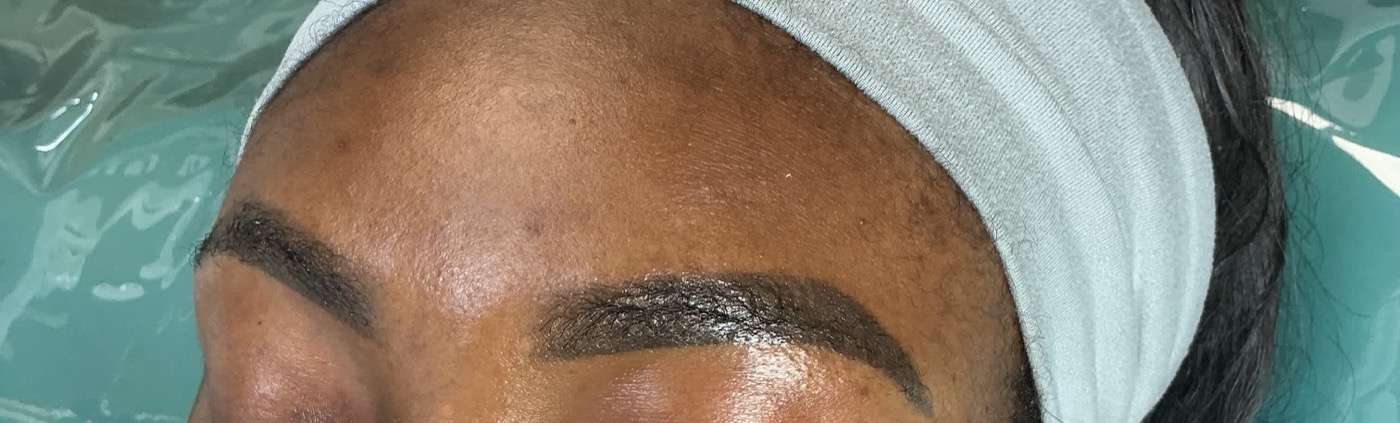 Eyebrow tattoo removal before photo on melanated skin in Atlanta, showing dark saturated 5-year-old permanent makeup brows