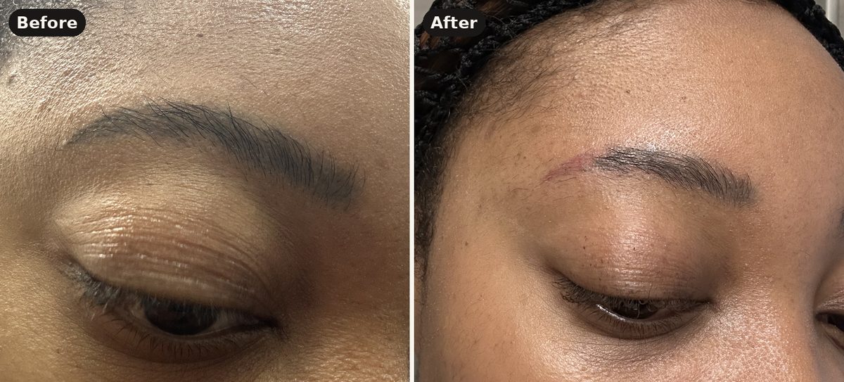 Dark eyebrow tattoo tail before and after laser removal, I Am Beautiful by Mia