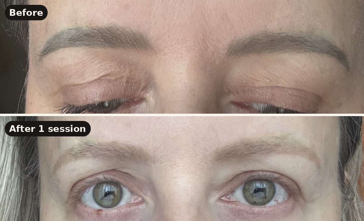 Old grey-toned eyebrow tattoo before laser removal and after one session, I Am Beautiful by Mia